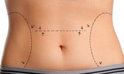 Абдоминопластика (пластика живота)