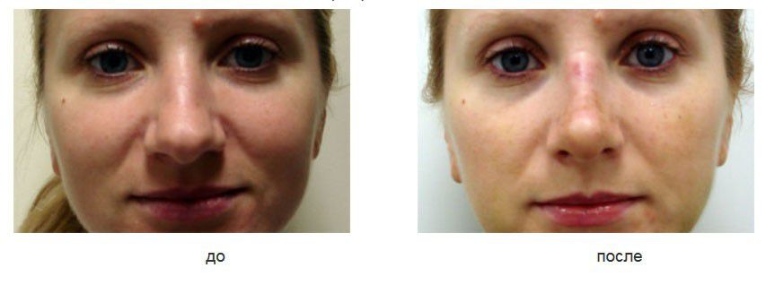 rinoplastika и пластика переднего отдела перегородки. rinoplastika и пластика переднего отдела перегородки.