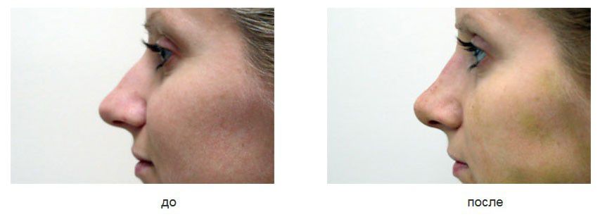 rinoplastika и пластика переднего отдела перегородки. rinoplastika и пластика переднего отдела перегородки.