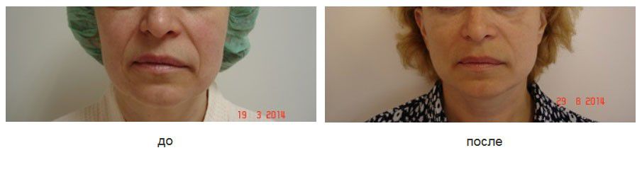 спейслифтинг с локализацией