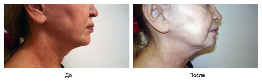 Верхняя и нижняя хейлопластика после некорректного увеличения губ
