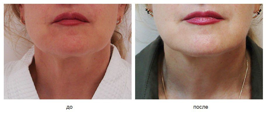 Подкожное рассечение краев платизмы, подтяжка шеи нитями Силуэт-Лифт