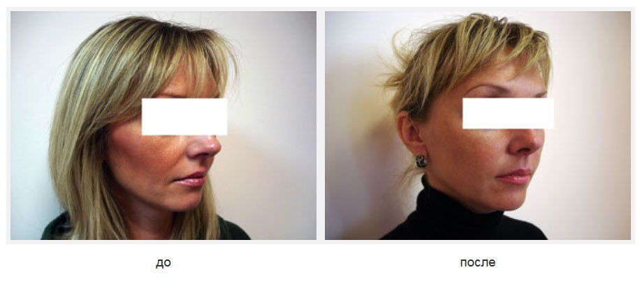 Подтяжка щек нитями Силуэт лифт.