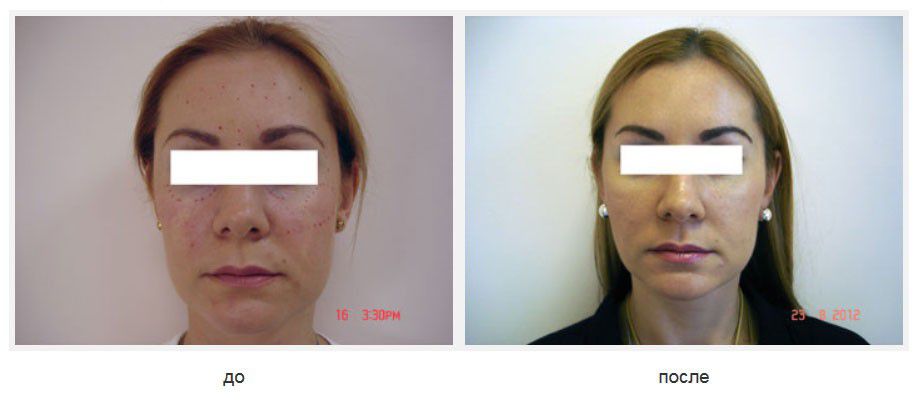 Подтяжка лица Силуэт-лифт, коррекция "запавших глаз" липофилингом подглазничных областей