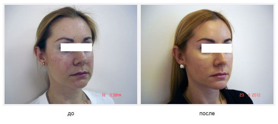 Подтяжка лица Силуэт-лифт, коррекция "запавших глаз" липофилингом подглазничных областей