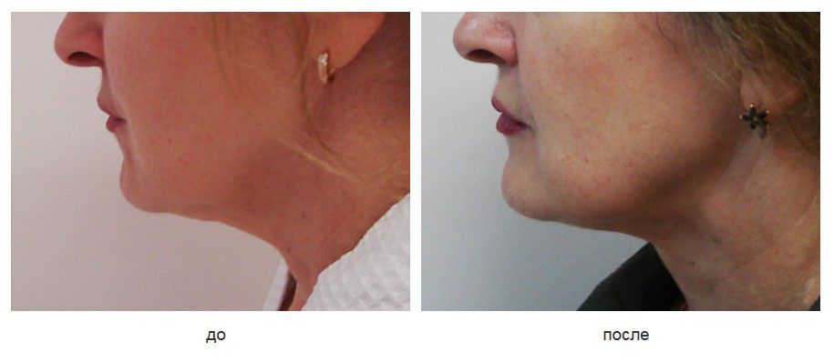 Подкожное рассечение краев платизмы, подтяжка шеи нитями Силуэт-Лифт