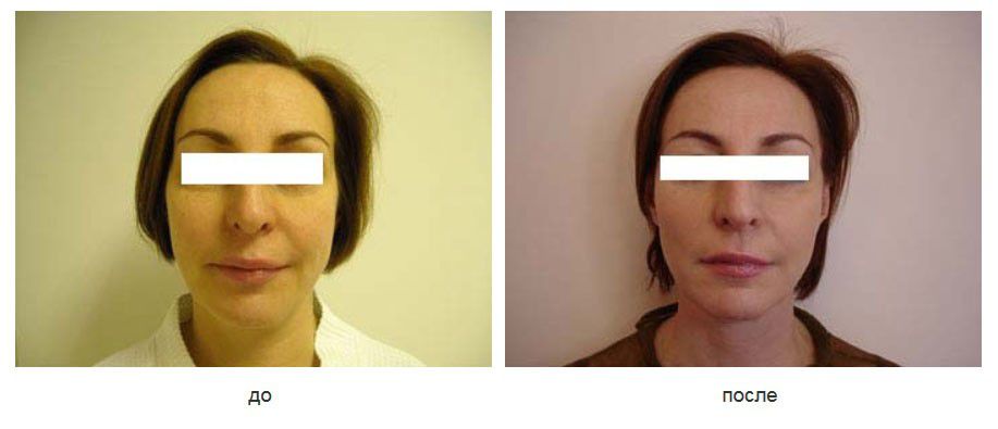 Подтяжка щек нитями Силуэт лифт.