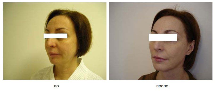 Подтяжка щек нитями Силуэт лифт.