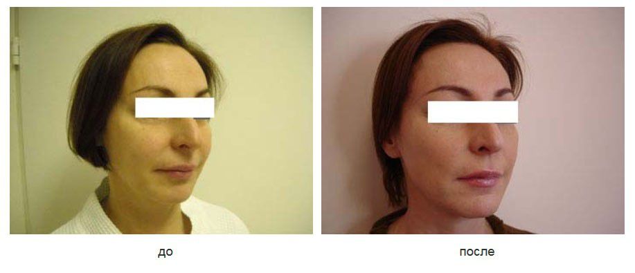 Подтяжка щек нитями Силуэт лифт.