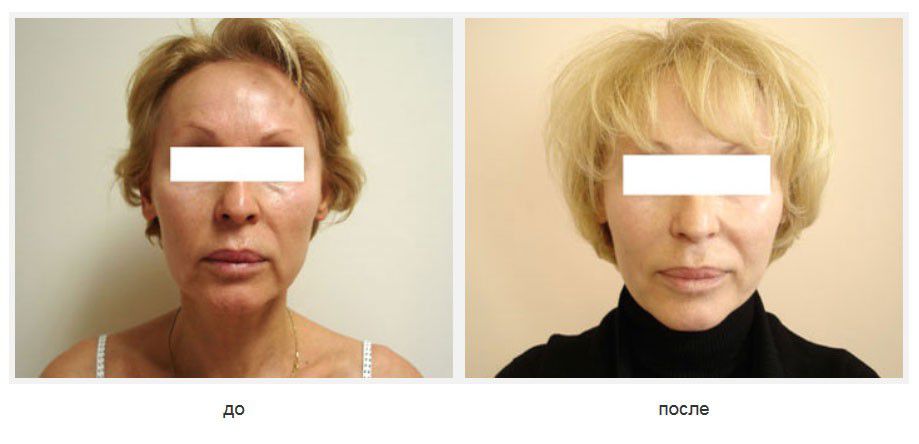 Подтяжка щек и подбородка нитями Силуэт-лифт