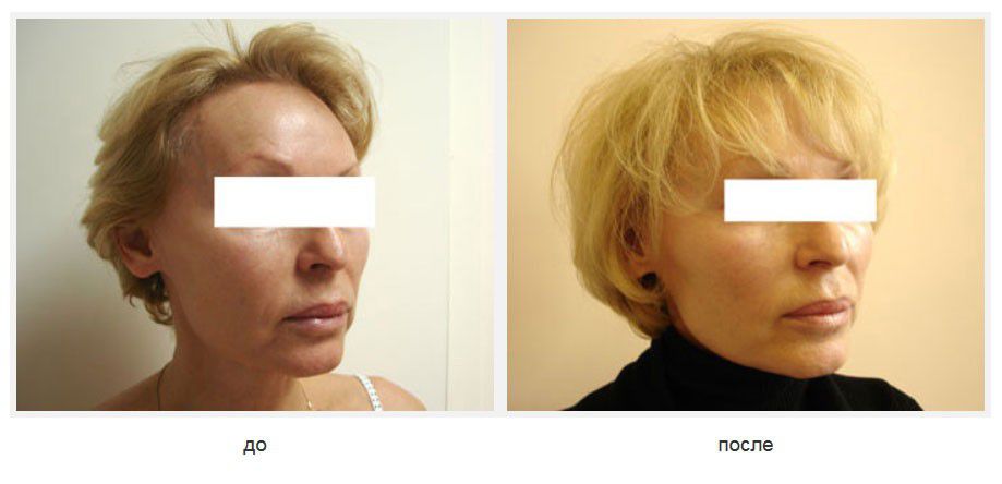 Подтяжка щек и подбородка нитями Силуэт-лифт