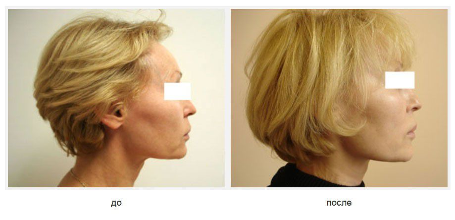 Подтяжка щек и подбородка нитями Силуэт-лифт