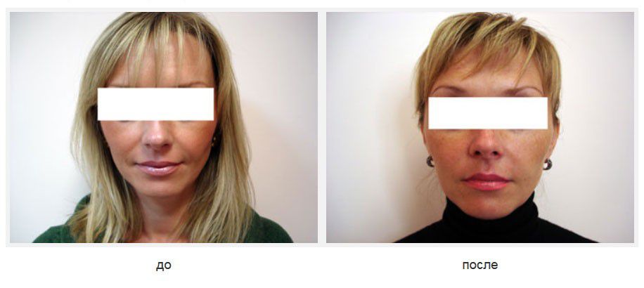 Подтяжка щек нитями Силуэт лифт.