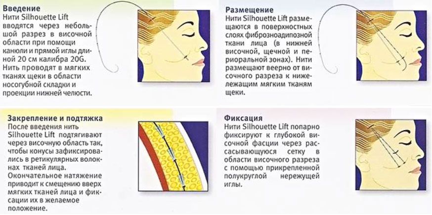 Техника лифтинга лица