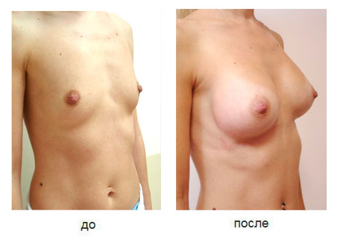 Результат эндоскопического увеличения груди через подмышку через 6 месяцев после операции. Объем анатомических имплантов 245 сс