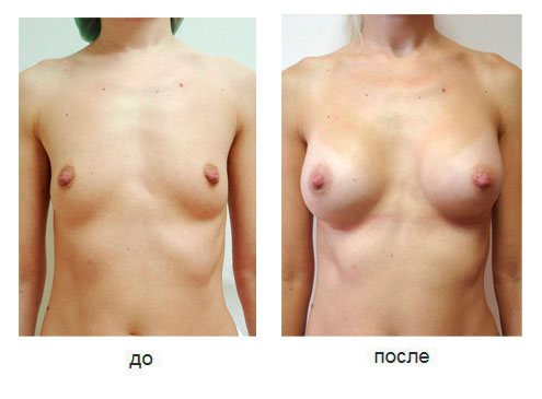 Результат эндоскопического увеличения груди через подмышку через 6 месяцев после операции. Объем анатомических имплантов 245 сс